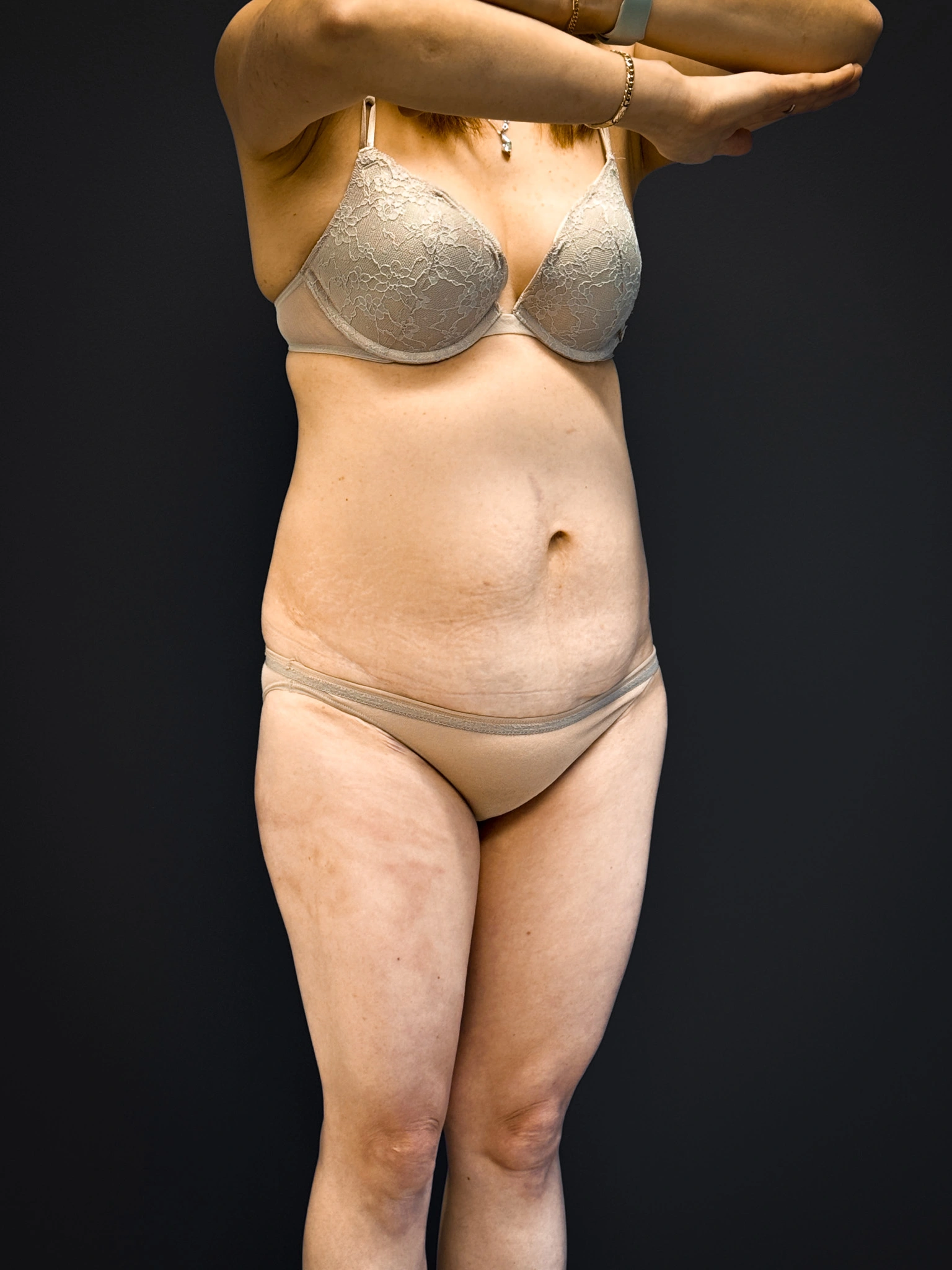 Tummy-Tuck-Case--5969 | Before Tummy Tuck 4