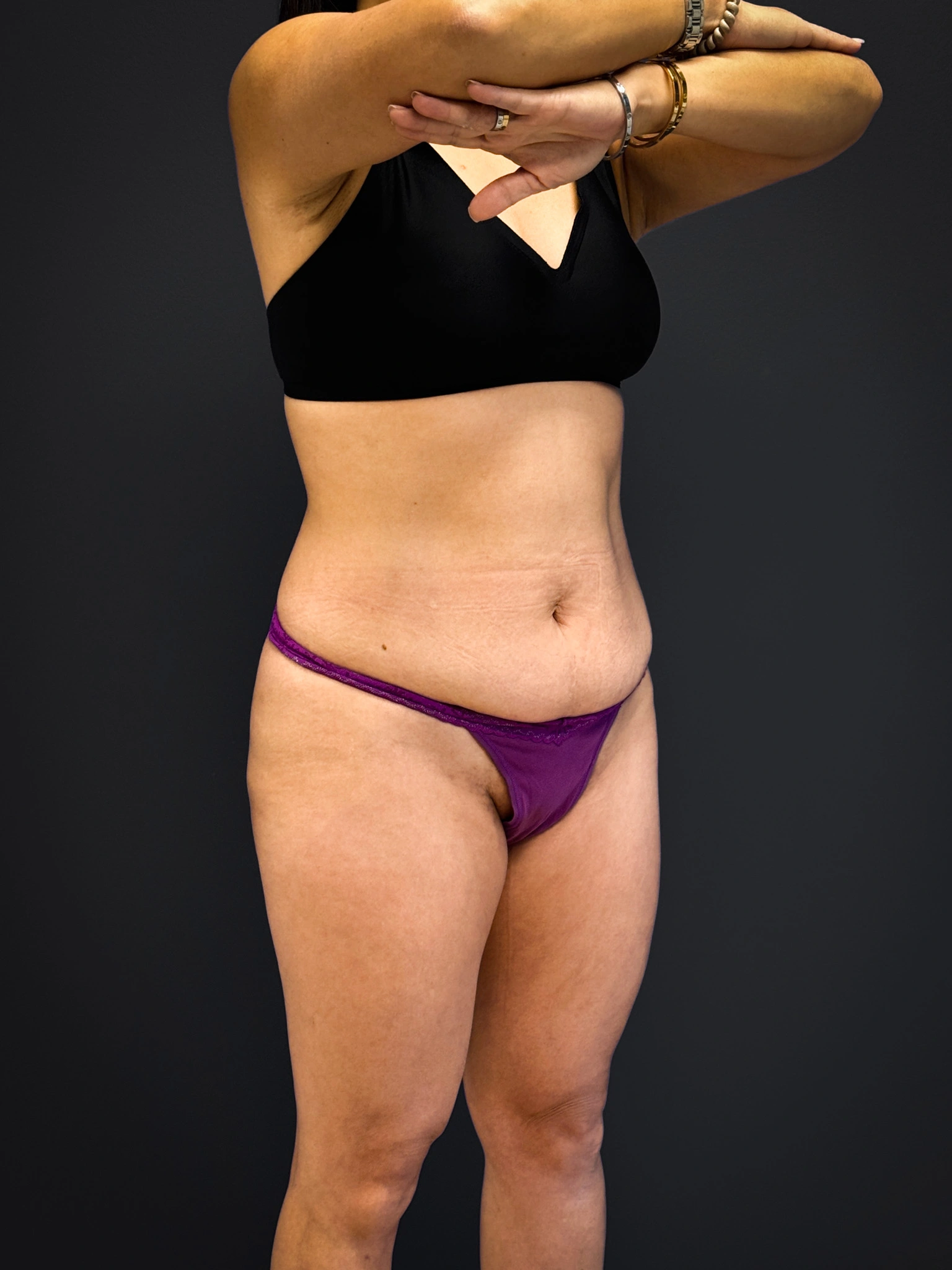 Tummy-Tuck-Case--3757 | Before Tummy Tuck 3