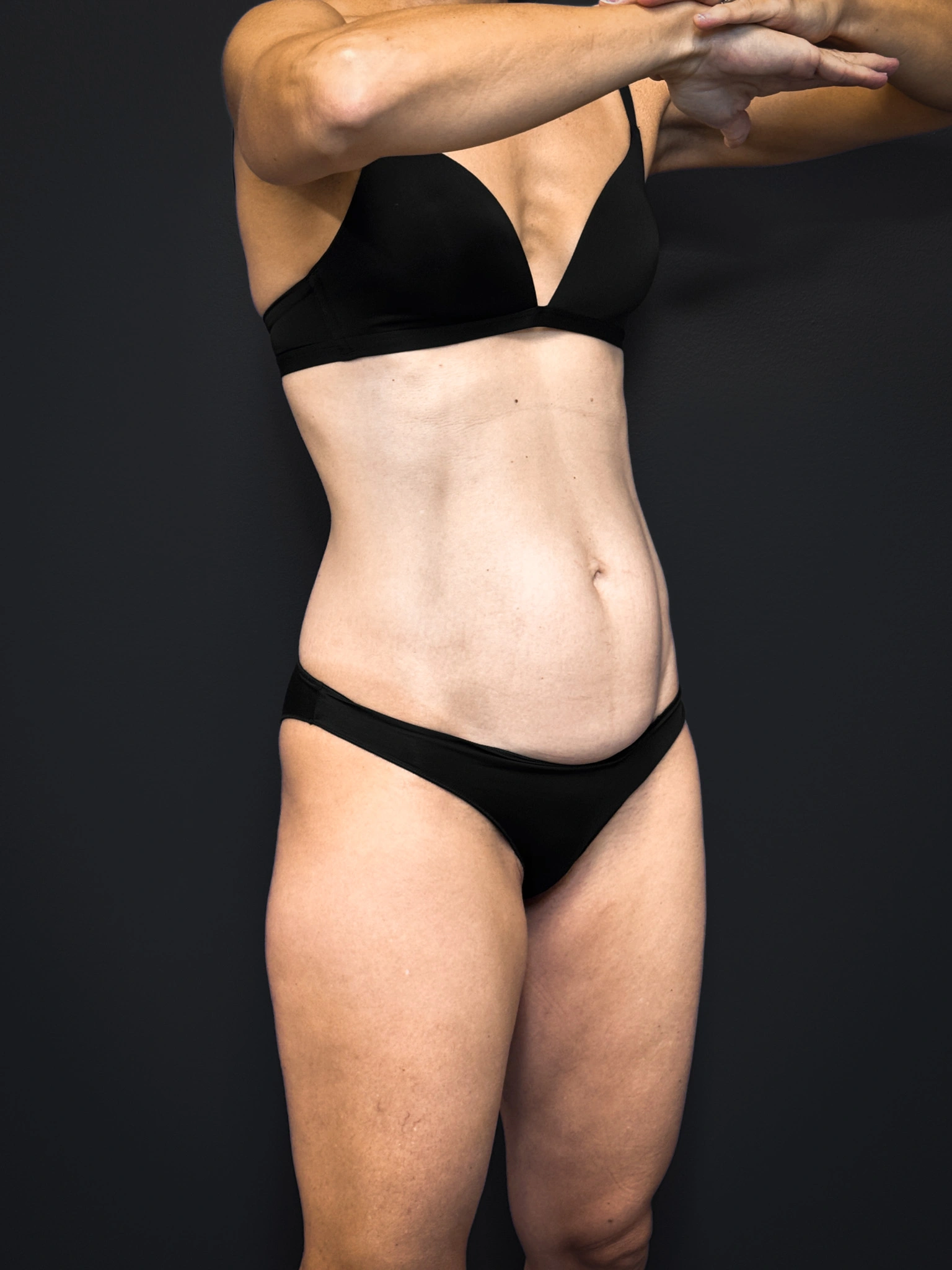 Tummy-Tuck-Case--2729 | Before Tummy Tuck 5