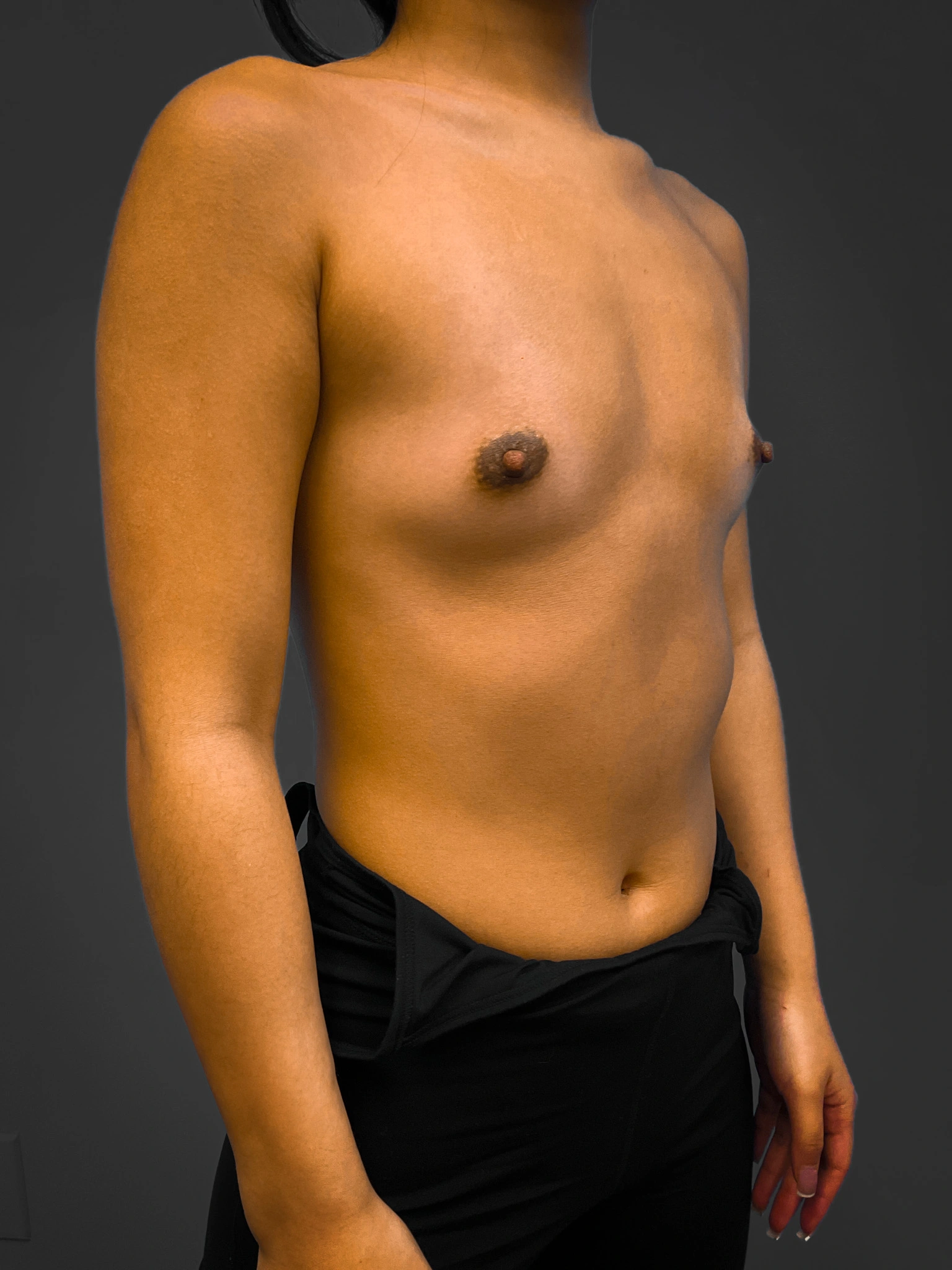 Breast-Augmentation-Case--4631 | Before Breast Augmentation 5