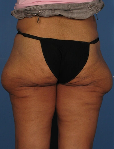 Thigh-lift-Case--75 | Before Thigh Lift 2