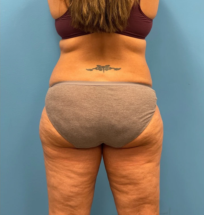 Lipoabdominoplasty-Case--25555 | Before Liposuction 4