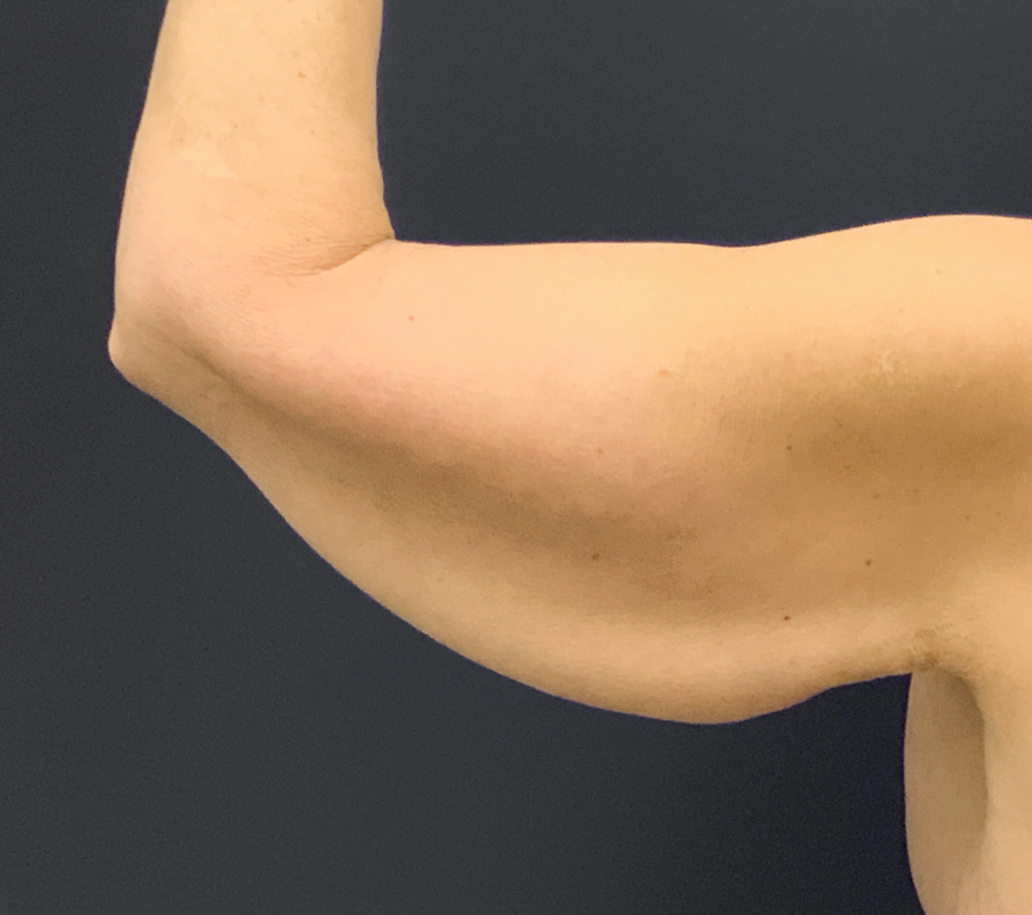 Brachioplasty-Case--6382 | Before Arm Lift 4