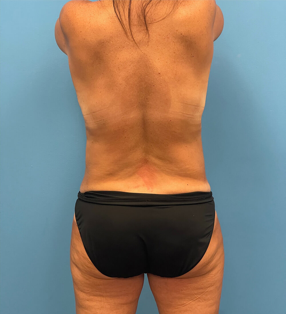 Mommy-Makeover-Case--26141 | Before Mommy Makeover 2