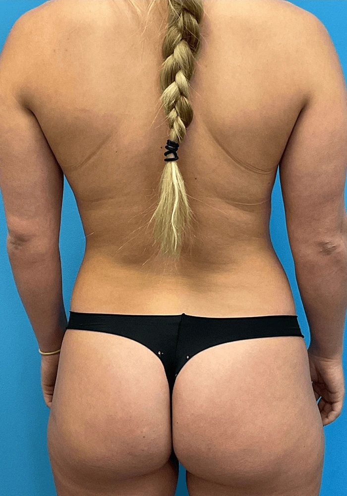 Breast-Augmentation-Case--23895 | Before Breast Augmentation 6