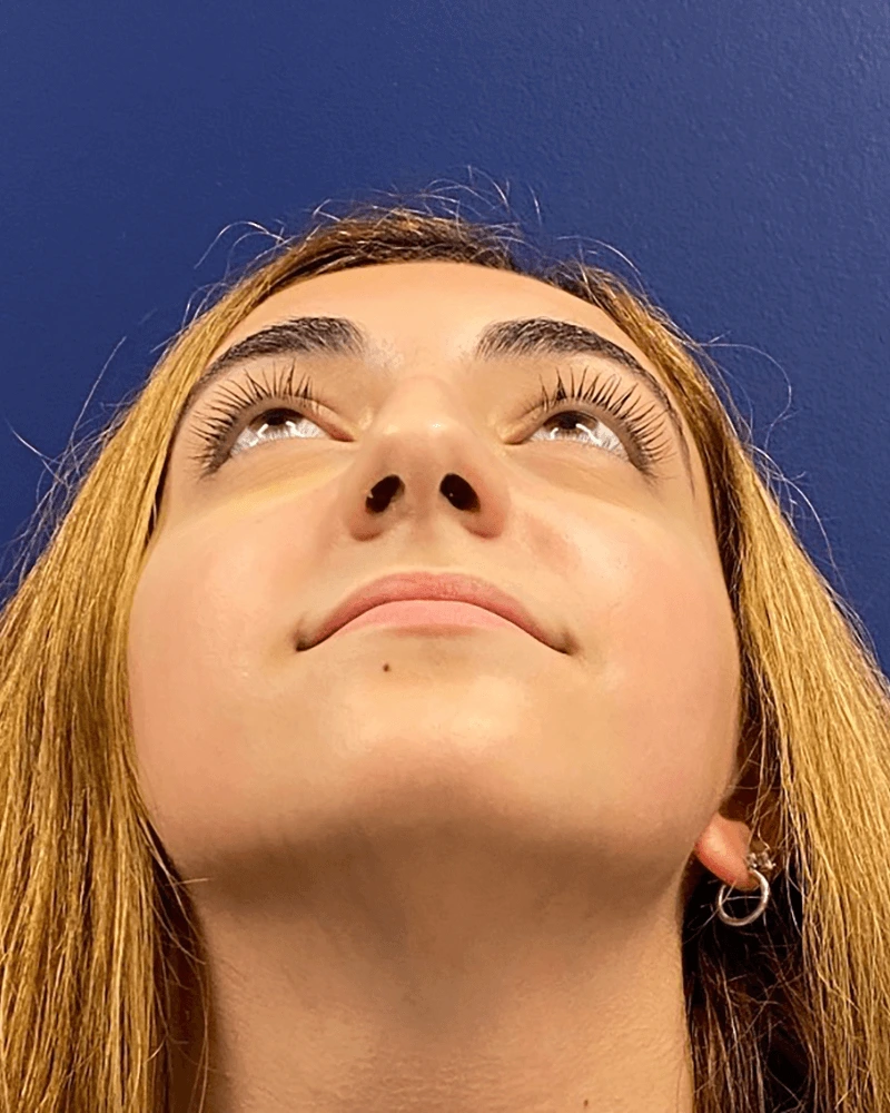 Rhinoplasty-Case--23921 | Before Rhinoplasty 6