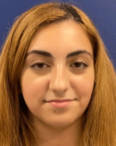 Rhinoplasty-Case--23921 | Before Rhinoplasty 1