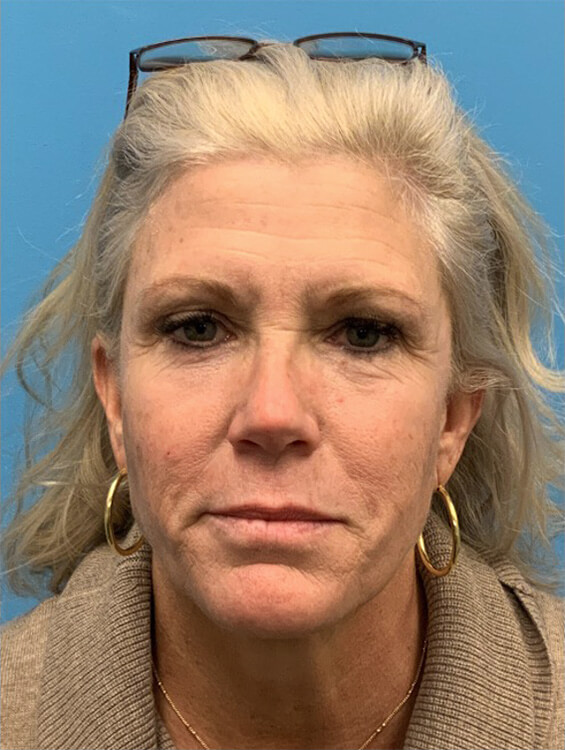 Face-and-Neck-Lift-Case--15055 | Before Face360 1