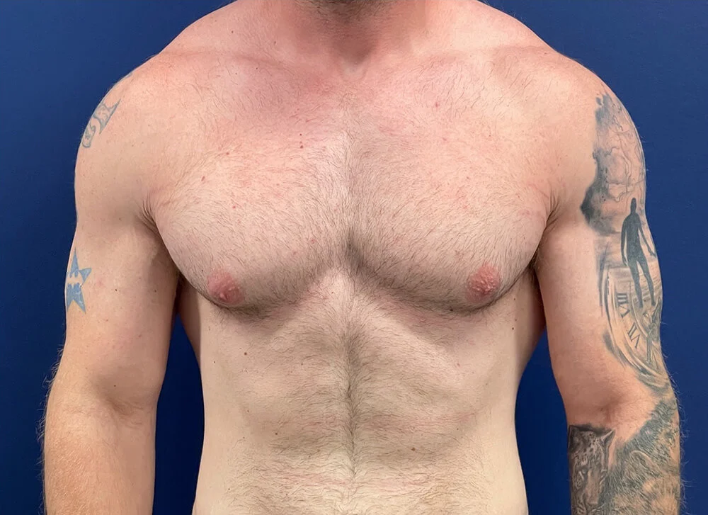 Gynecomastia-Case--28230 | Before Gynecomastia / Male Breast Reduction 1