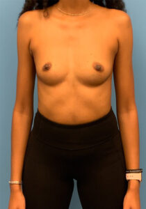 Breast-Augmentation-Case--26022 | Before Breast Augmentation 1