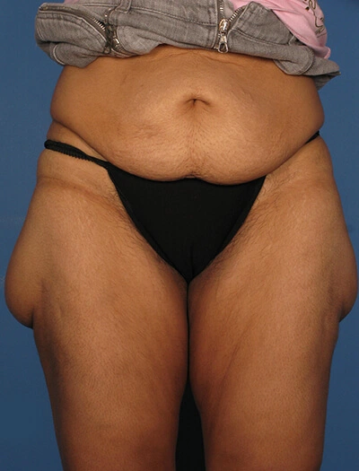 Thigh-lift-Case--75 | Before Thigh Lift 1