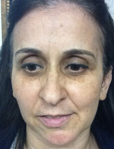 Chemical-Peel-Case--36 | Before Skin Care 1