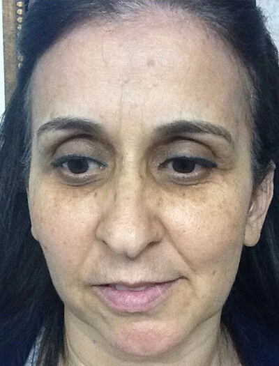 Chemical-Peel-Case--36 | Before Skin Care 1