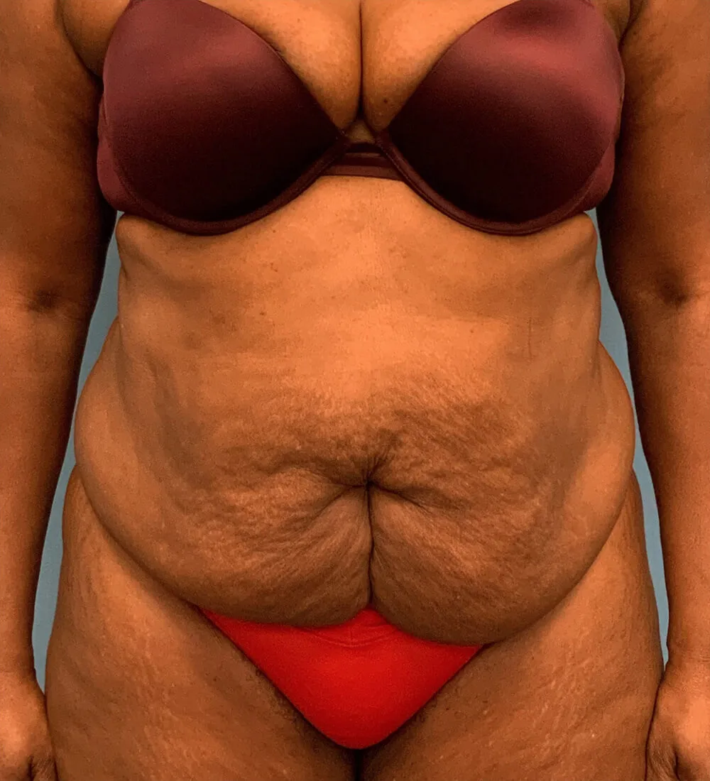 Lipoabdominoplasty-Case--24124 | Before Tummy Tuck 1
