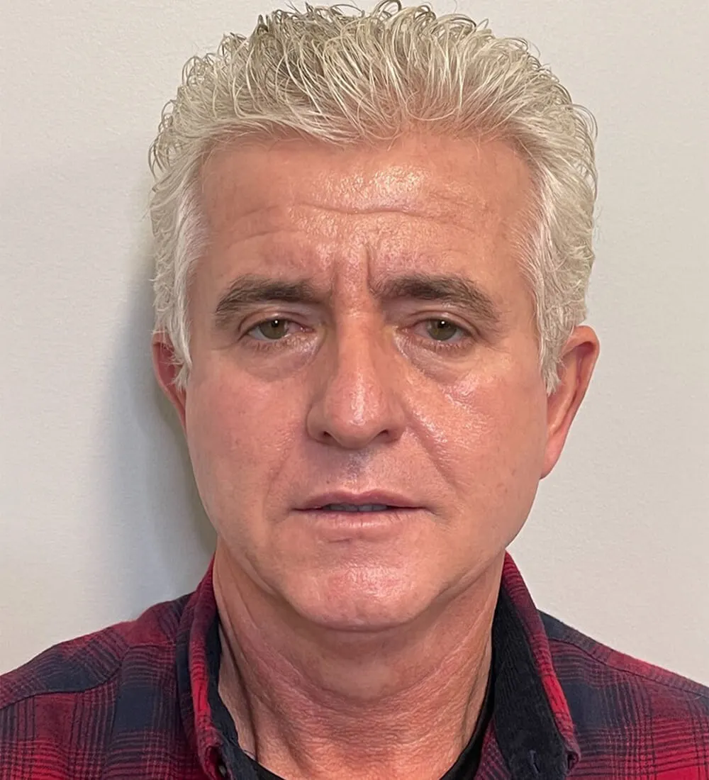 Facelift-Blepharoplasty-Case--291 | Before Facelift for Men 1