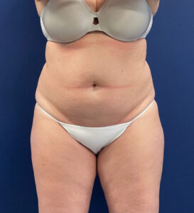 Lipoabdominoplasty-Case--24903 | Before Tummy Tuck 1