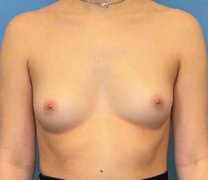Breast-Augmentation-Case--224 | Before Dr. Samir Rao 1