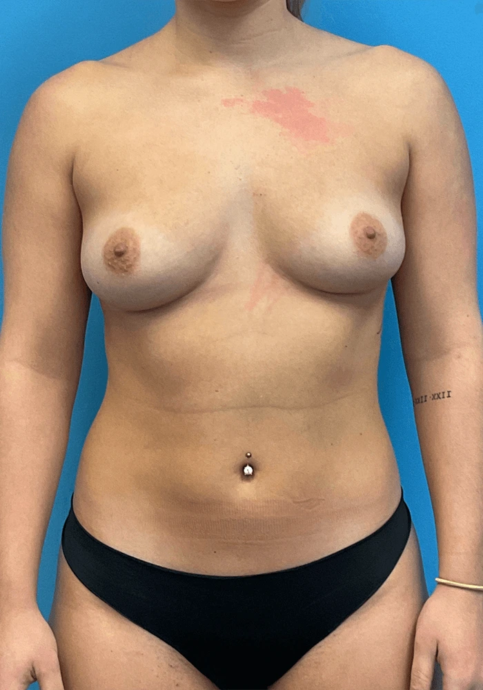 Breast-Augmentation-Case--23895 | Before Breast Augmentation 1