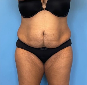 Lipoabdominoplasty-Case--255 | Before Liposuction 1