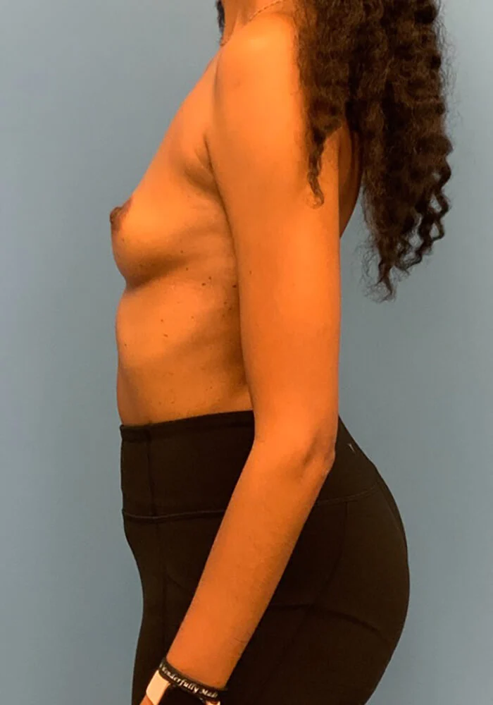 Breast-Augmentation-Case--26022 | Before Breast Augmentation 3