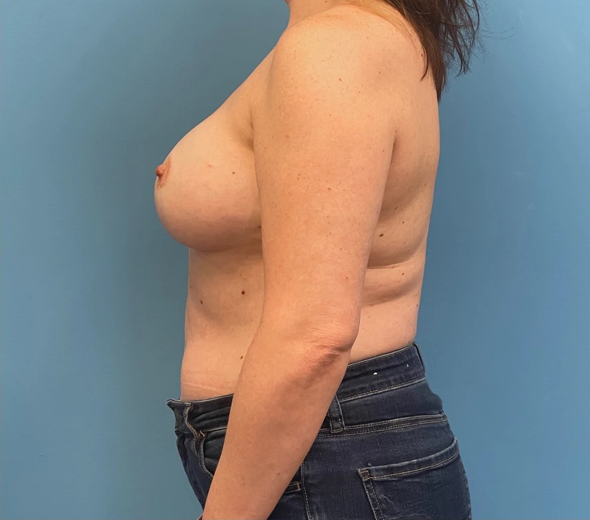 Breast-Reconstruction-Case--27065 | Before Breast Reconstruction 3