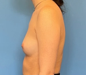 Breast-Augmentation-Case--224 | Before Dr. Samir Rao 2