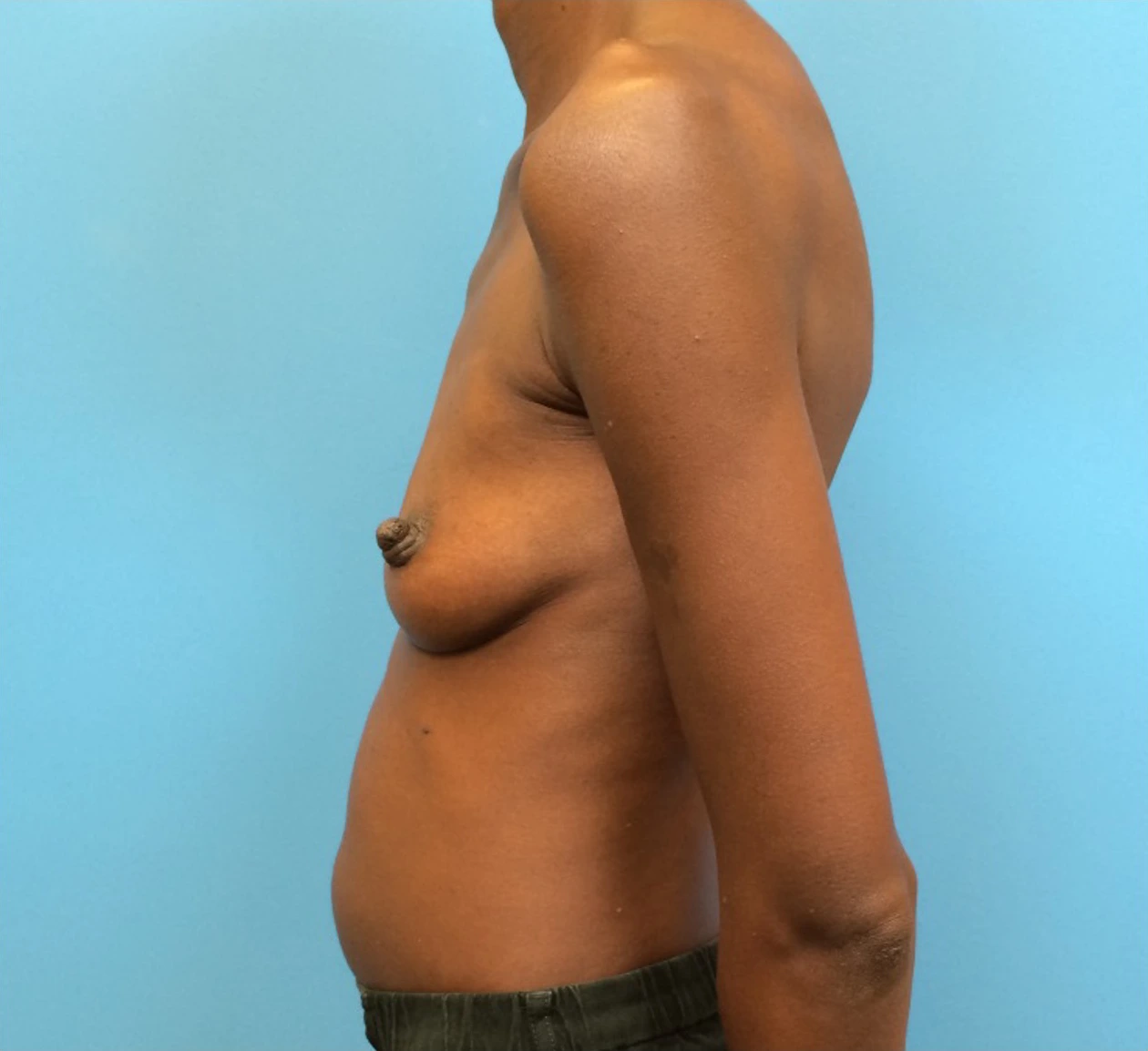 Case--97 | Before Breast Augmentation 2