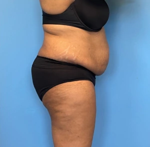 Lipoabdominoplasty-Case--255 | Before Liposuction 2