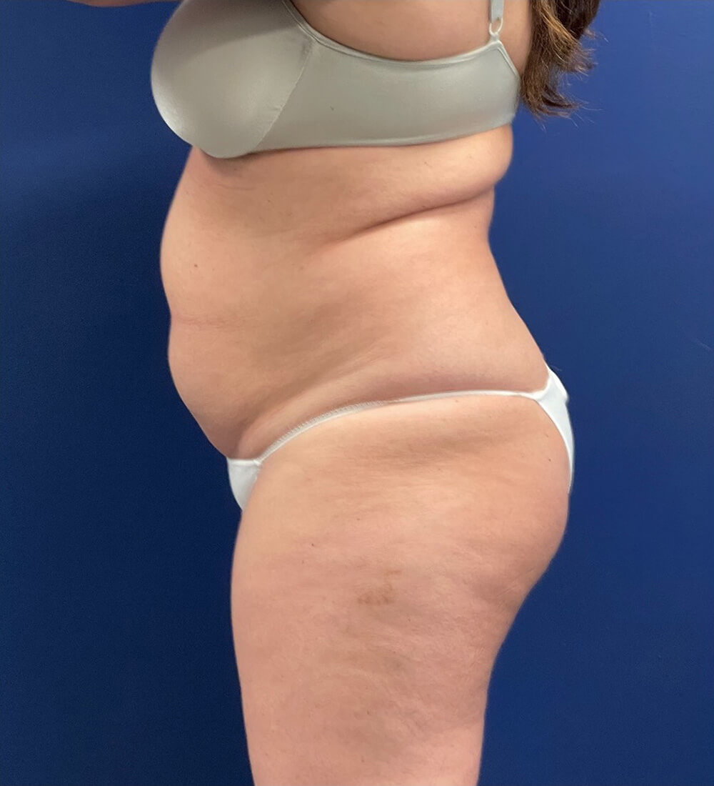 Lipoabdominoplasty-Case--24903 | Before Tummy Tuck 3