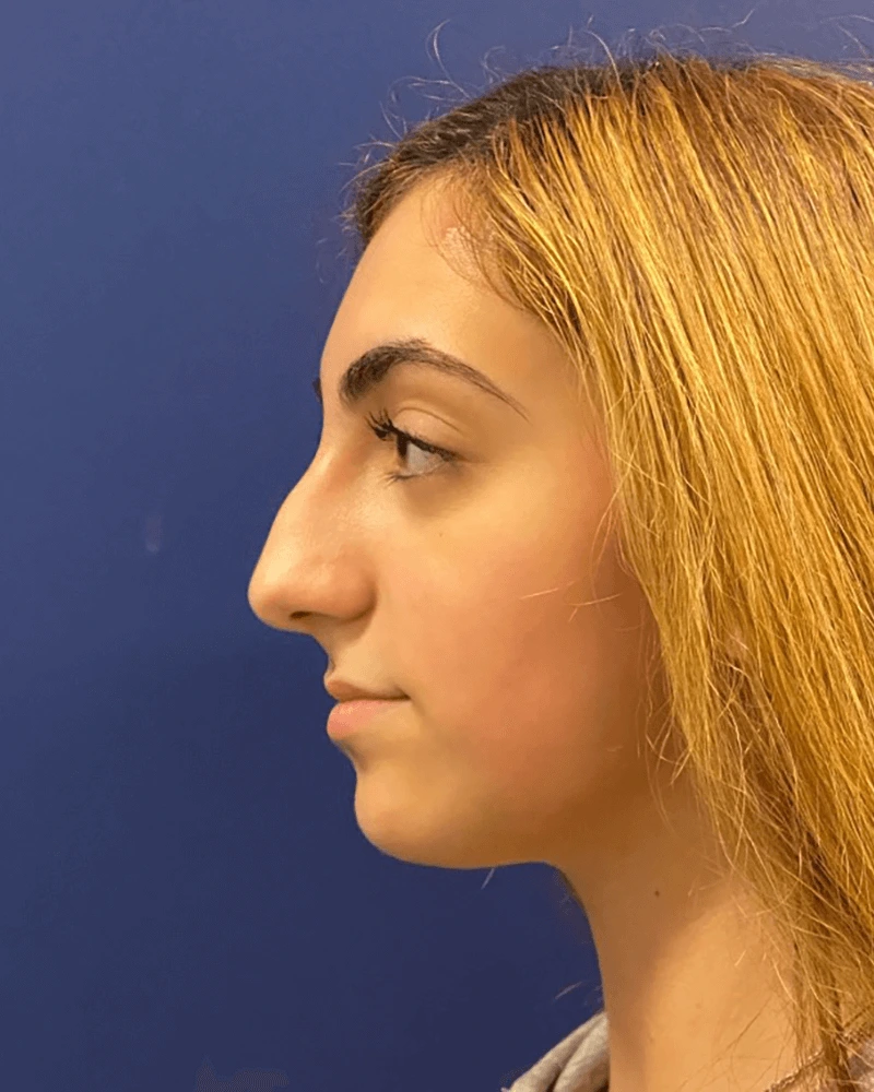 Rhinoplasty-Case--23921 | Before Rhinoplasty 3