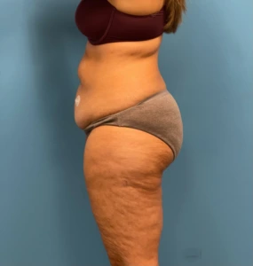 Lipoabdominoplasty-Case--25555 | Before Liposuction 2