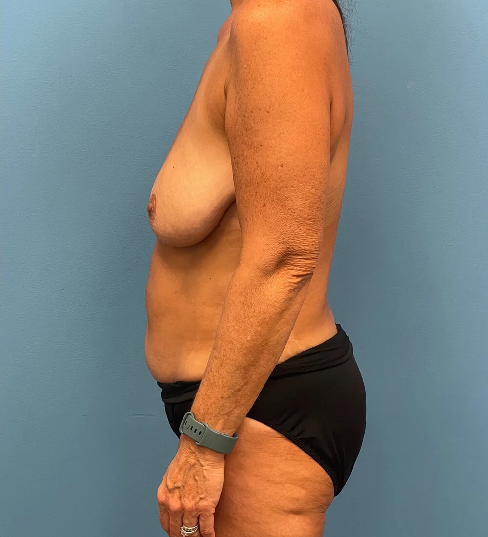 Mommy-Makeover-Case--26141 | Before Mommy Makeover 3