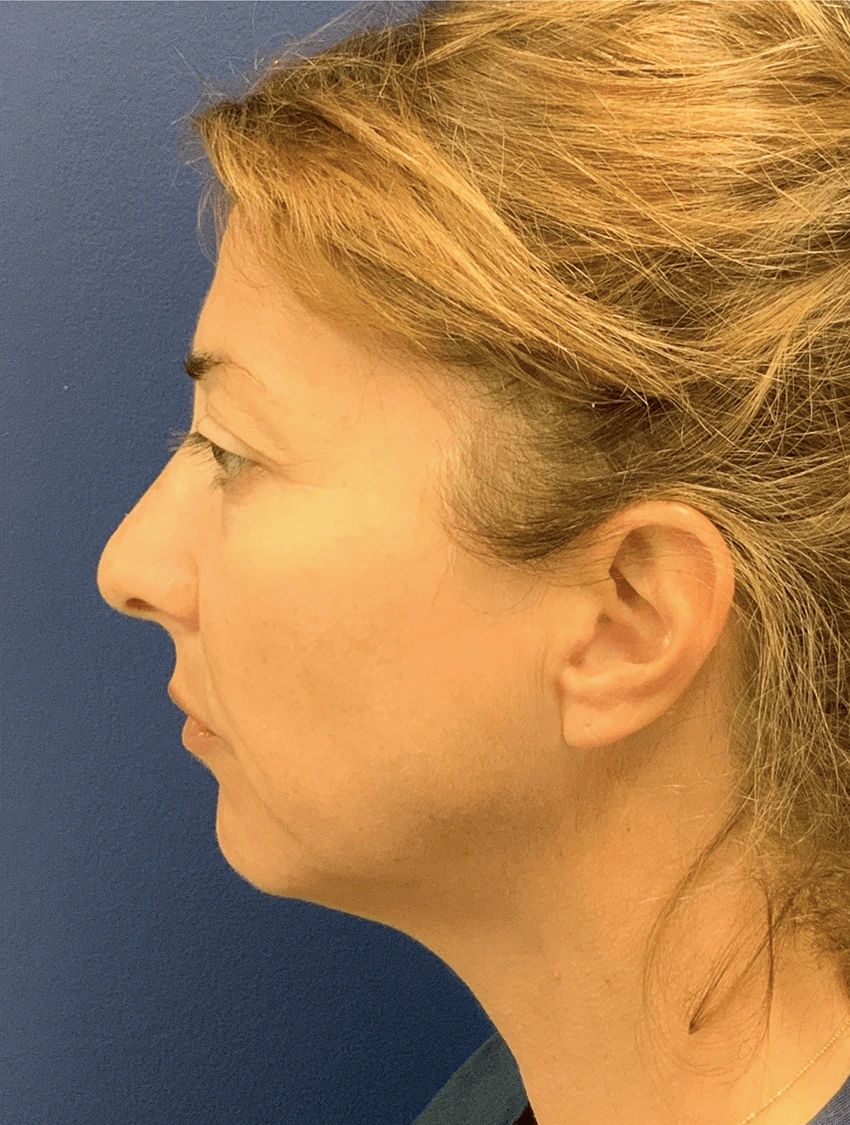 Case--20575 | Before Facelift 5