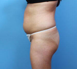 Brazilian-Butt-Lift-Case--265 | Before Dr. Samir Rao 1