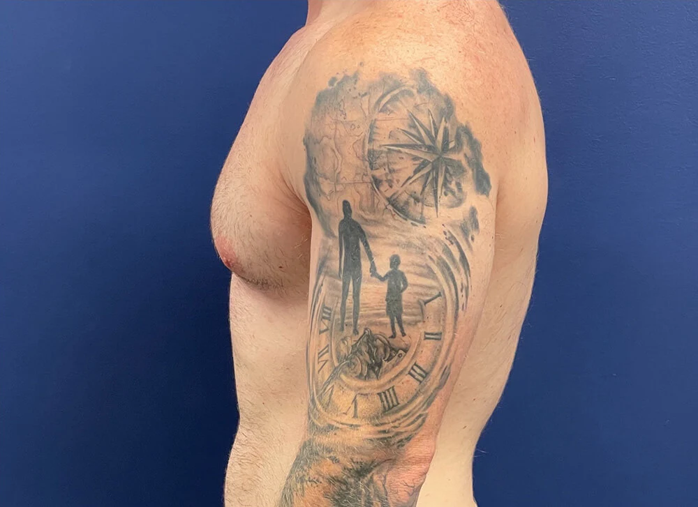 Gynecomastia-Case--28230 | Before Gynecomastia / Male Breast Reduction 3