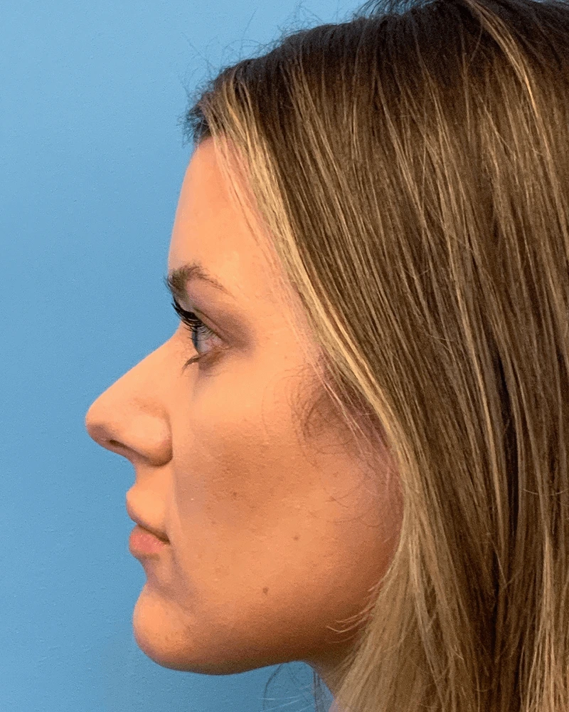 Rhinoplasty-Case--23703 | Before Rhinoplasty 3