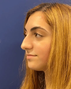 Rhinoplasty-Case--23921 | Before Rhinoplasty 2