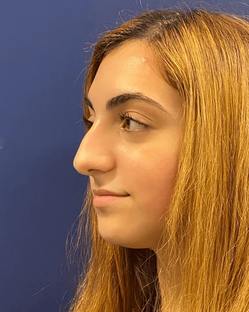 Rhinoplasty-Case--23921 | Before Rhinoplasty 2