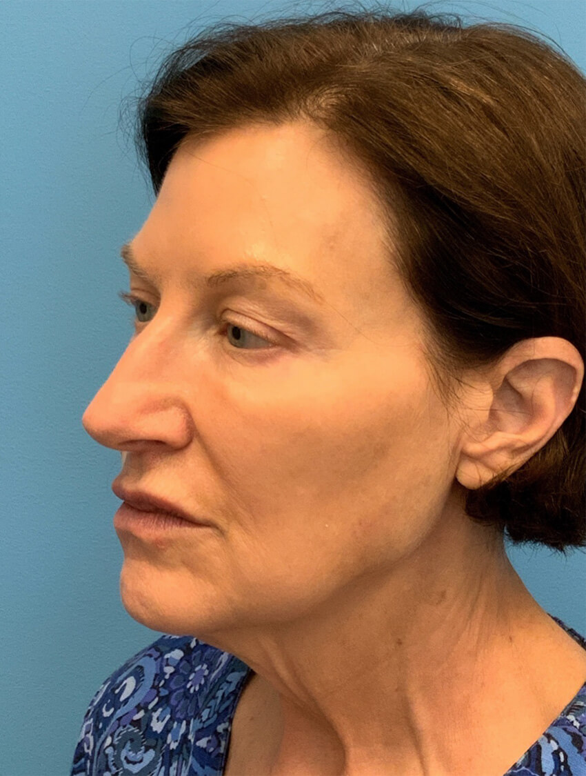 Case--9966 | Before Facelift 3