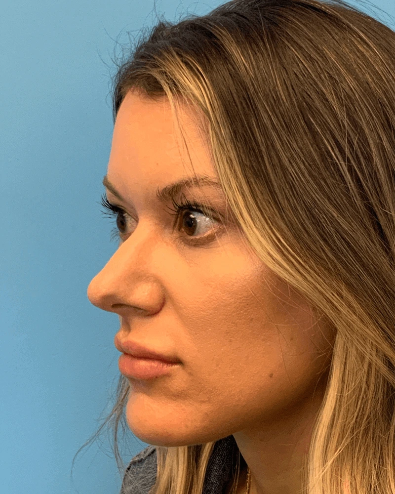 Rhinoplasty-Case--23703 | Before Rhinoplasty 4