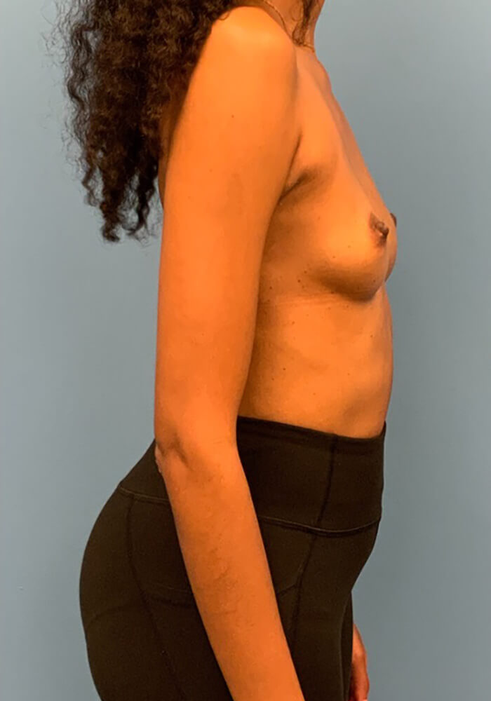 Breast-Augmentation-Case--26022 | Before Breast Augmentation 2