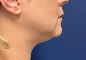 Case--20811 | Before Submental Liposuction 2