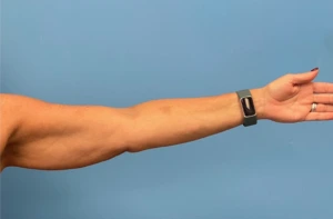Left arm profile of patient before undergoing brachioplasty procedure