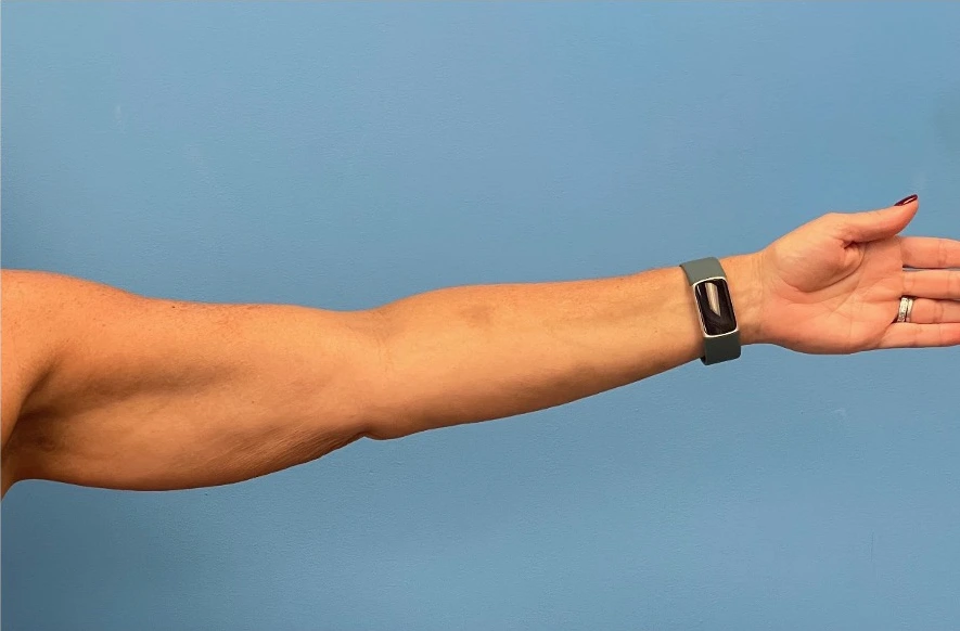 Left arm profile of patient before undergoing brachioplasty procedure