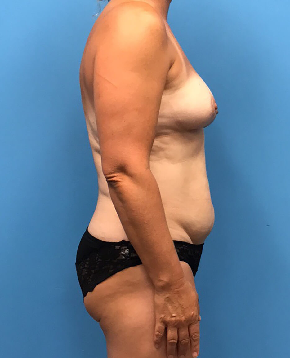 DIEP-Flap-Case--139 | Before DIEP Flap 2