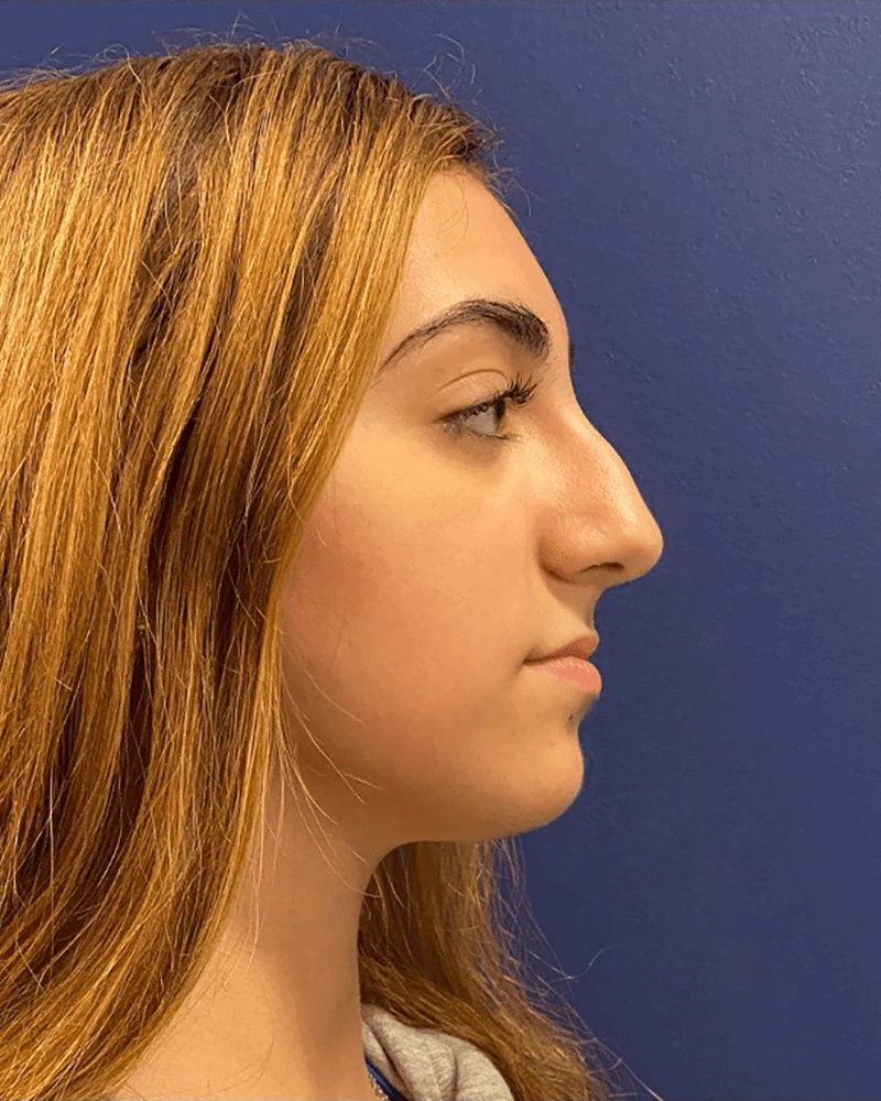Rhinoplasty-Case--23921 | Before Rhinoplasty 5