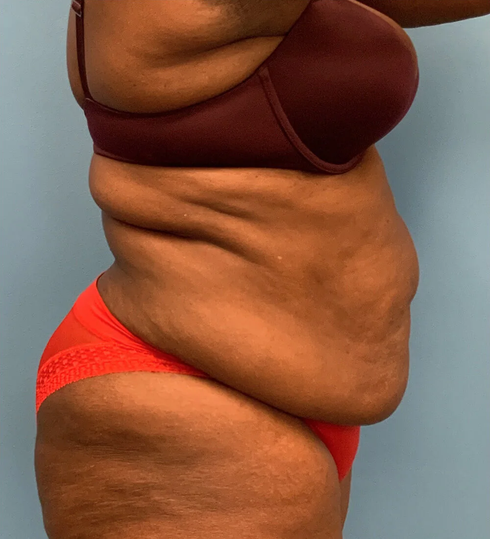 Lipoabdominoplasty-Case--24124 | Before Tummy Tuck 5