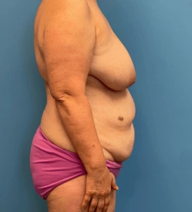 Lipoabdominoplasty-Case--24903 | Before Tummy Tuck 2