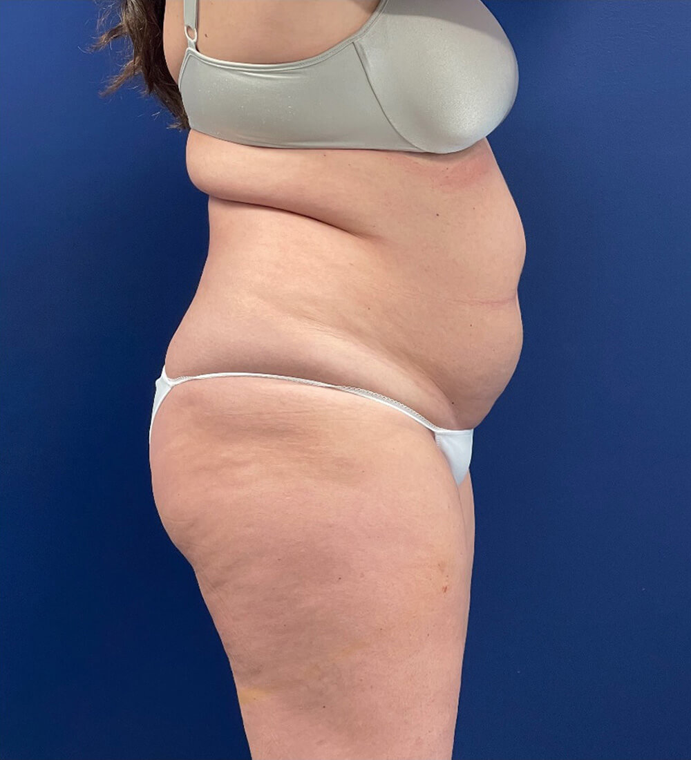 Lipoabdominoplasty-Case--24903 | Before Tummy Tuck 2