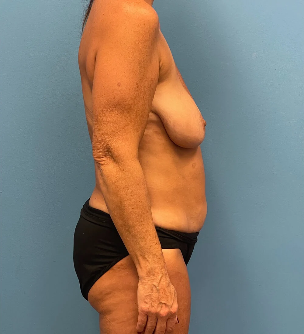 Mommy-Makeover-Case--26141 | Before Mommy Makeover 4